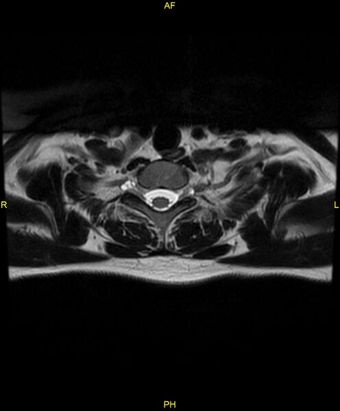 File:C5 nerve sheath tumor (Radiopaedia 85777-101596 Axial T2 80).jpg