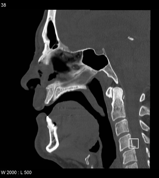 File:Calcification of the transverse band of the cruciform ligament (Radiopaedia 53063-59025 Sagittal bone window 15).jpg