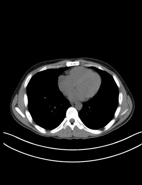 File:Calcifying pulmonary metastases (Radiopaedia 33359-34396 Axial non-contrast 20).jpg