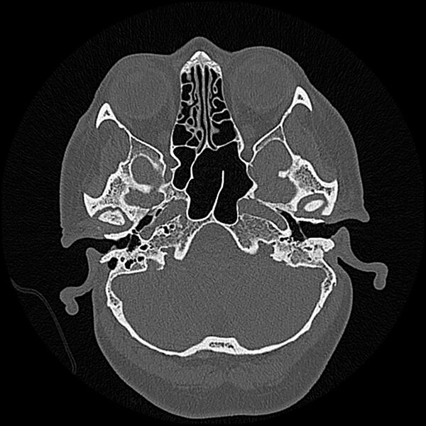 File:Canal up mastoidectomy (Radiopaedia 78108-90638 Axial bone window 52).jpg