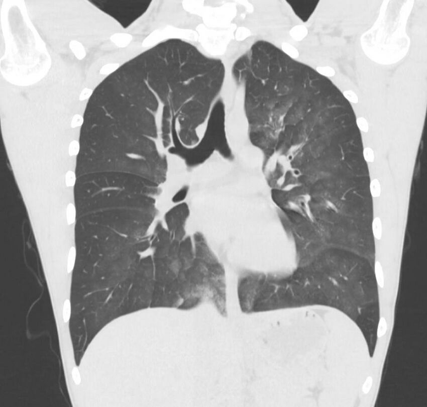 Cannabis-induced diffuse alveolar hemorrhage (Radiopaedia 89834-106946 Coronal lung window 45).jpg