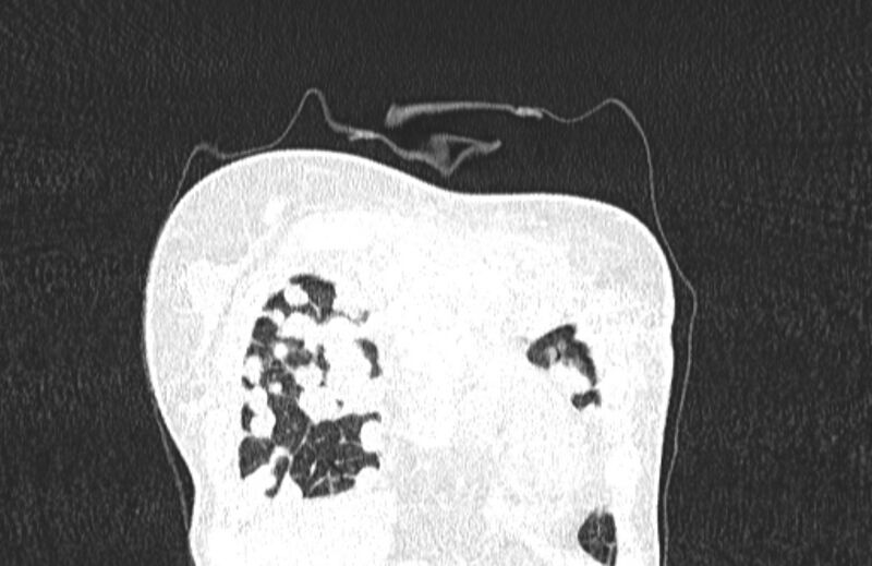 File:Cannonball metastases from breast cancer (Radiopaedia 91024-108569 Coronal lung window 15).jpg