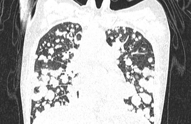 File:Cannonball metastases from breast cancer (Radiopaedia 91024-108569 Coronal lung window 61).jpg