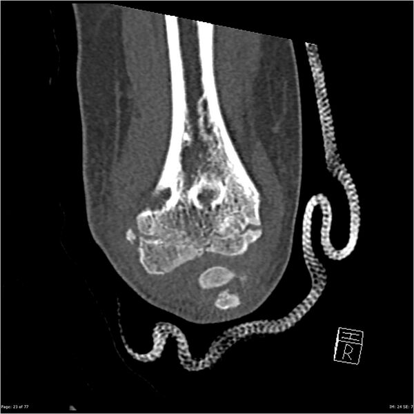 File:Capitellum fracture (Radiopaedia 23352-23426 Coronal bone window 23).jpg