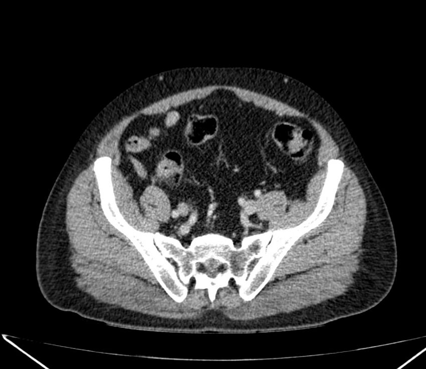 Carcinoid tumor with hepatic metastases (Radiopaedia 22651-22670 C 65).jpg