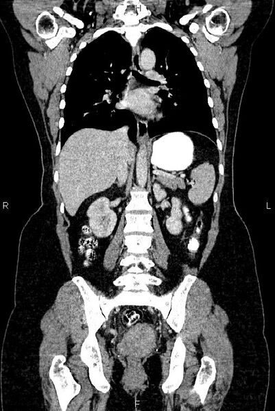 File:Carcinoma of uterine cervix (Radiopaedia 85861-101700 C 35).jpg