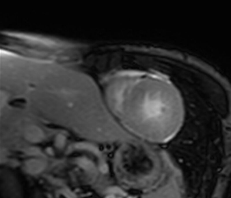 Cardiac amyloidosis (Radiopaedia 39736-42124 F 104).jpg