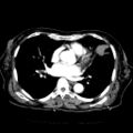 Cardiac fibroma (Radiopaedia 38974-41149 A 1).jpg