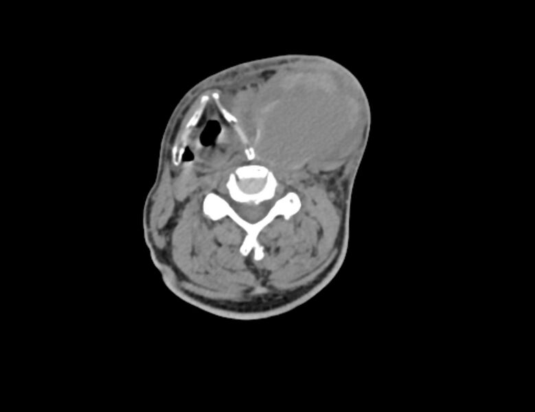 File:Carotid artery pseudoaneurysm (Radiopaedia 84030-99259 Axial non-contrast 28).jpg