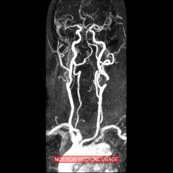 File:Carotid artery stenosis (Radiopaedia 28786-29087 3D MRA 10).jpg