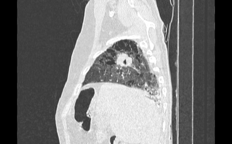 File:Cavitating bronchogenic carcinoma (Radiopaedia 44489-48162 Sagittal lung window 5).jpg