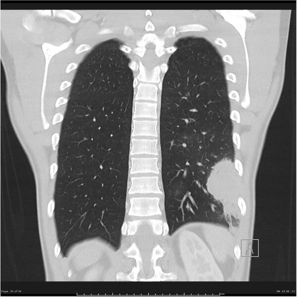File:Cavitating lung cancer (Radiopaedia 25796-25945 lung window 35).jpg