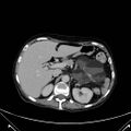 Cavitating mesenteric lymph node syndrome in celiac disease (Radiopaedia 59614).jpg