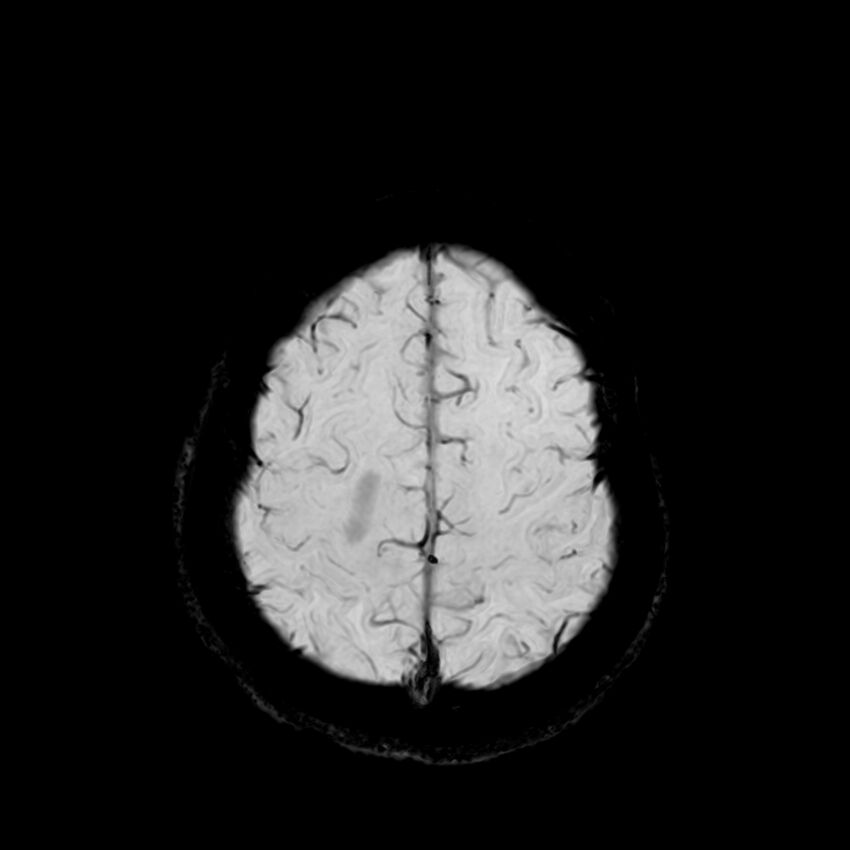 Central neurocytoma (Radiopaedia 79320-92380 Axial SWI 116).jpg
