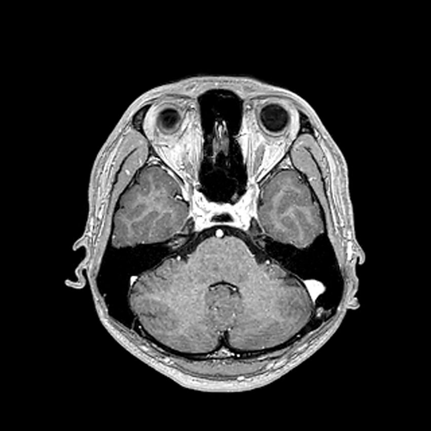 Central neurocytoma (Radiopaedia 79320-92380 Axial T1 C+ 81).jpg