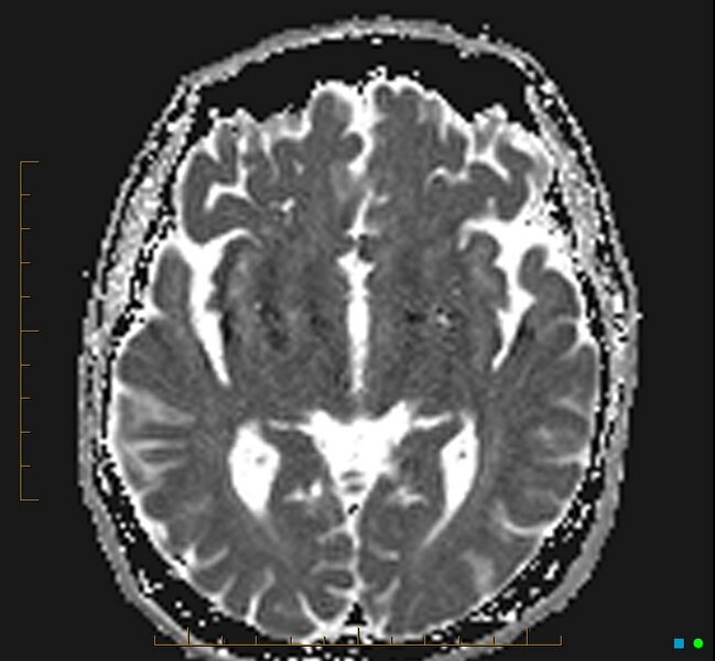 File:Cerebellar gangliocytoma (Radiopaedia 65377-74422 Axial ADC 18).jpg