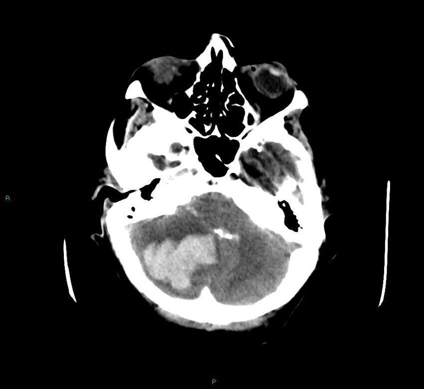 Cerebellar hemorrhage (Radiopaedia 58792-66026 Axial non-contrast 40).jpg