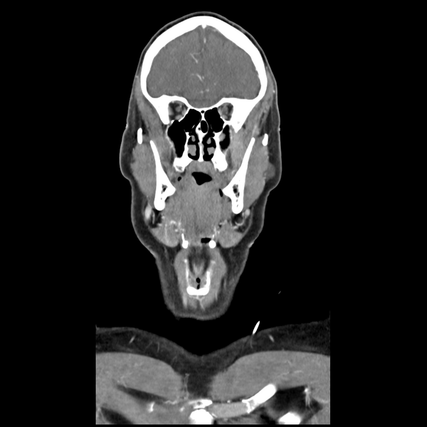 File:Cerebellar infarct due to vertebral artery dissection with posterior fossa decompression (Radiopaedia 82779-97029 D 17).png