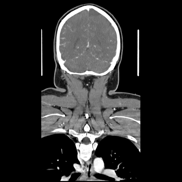 File:Cerebellar infarct due to vertebral artery dissection with posterior fossa decompression (Radiopaedia 82779-97029 D 49).png