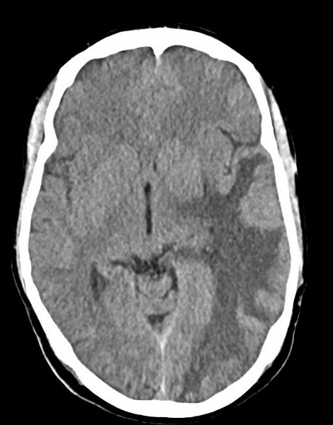 File:Cerebral abscesses (Radiopaedia 70458-80568 Axial non-contrast 30).jpg