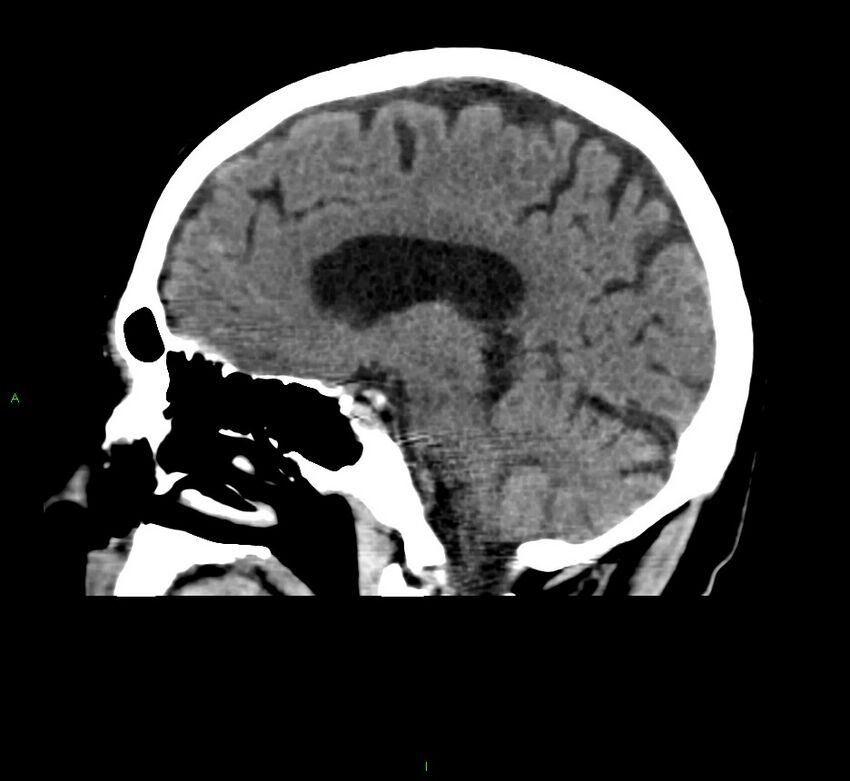 Cerebral amyloid angiopathy-associated lobar intracerebral hemorrhage (Radiopaedia 58376-65511 C 30).jpg