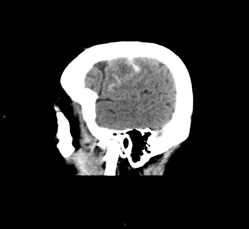 Cerebral amyloid angiopathy-associated lobar intracerebral hemorrhage (Radiopaedia 58376-65511 C 45).jpg