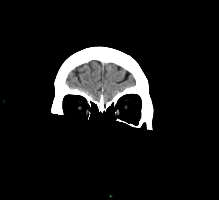 Cerebral amyloid angiopathy-associated lobar intracerebral hemorrhage (Radiopaedia 58378-65516 Coronal non-contrast 52).jpg
