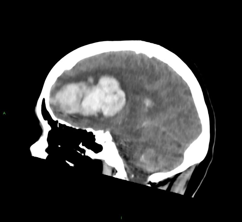Cerebral amyloid angiopathy-associated lobar intracerebral hemorrhage (Radiopaedia 58752-65973 C 31).jpg
