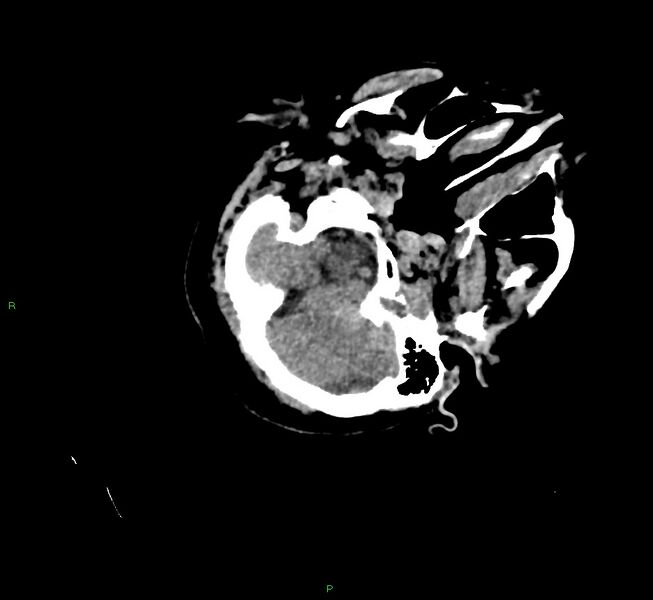 File:Cerebral amyloid angiopathy-associated lobar intracerebral hemorrhage (Radiopaedia 58757-65979 Axial non-contrast 23).jpg