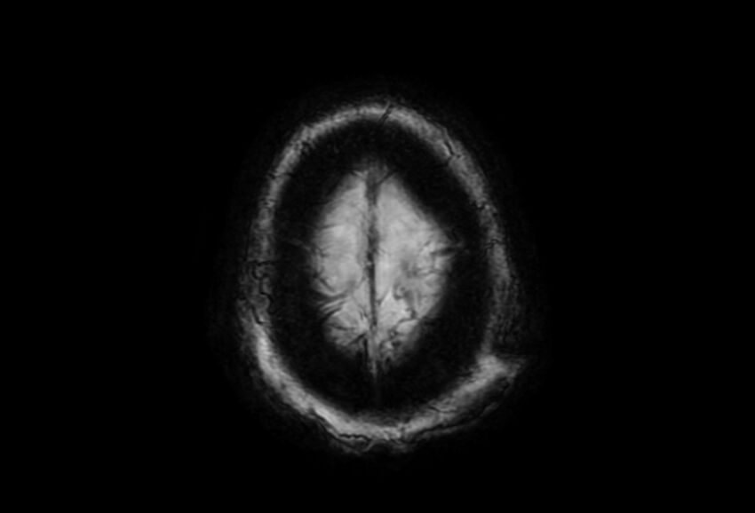 Cerebral amyloid angiopathy (Radiopaedia 86671-102792 Axial Gradient Echo 2).jpg