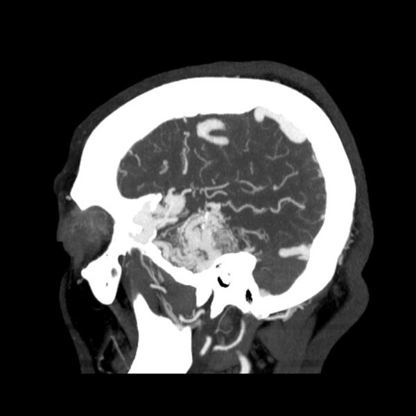 File:Cerebral arteriovenous malformation (Radiopaedia 43729-47189 D 41).jpg