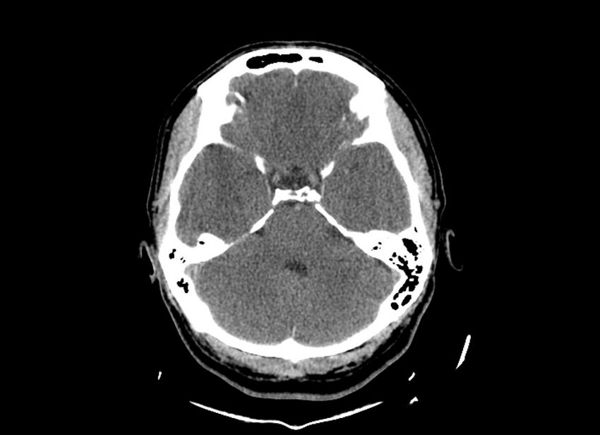 Cerebral edema (Radiopaedia 82519-96661 Axial non-contrast 39).jpg