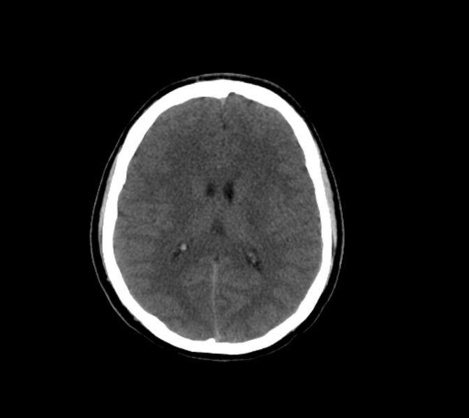 File:Cerebral fat embolism (Radiopaedia 37510-39362 Axial non-contrast 20).jpg
