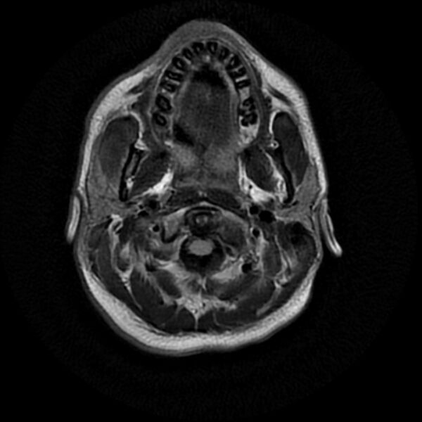 File:Cerebral fat embolism (Radiopaedia 37510-39363 Axial FLAIR 2).jpg