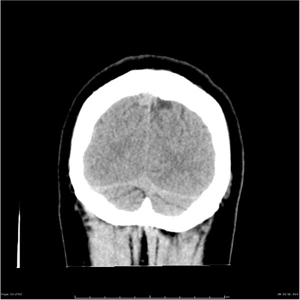 File:Cerebral hemorrhage secondary to arteriovenous malformation (Radiopaedia 33497-34561 Coronal non-contrast 50).jpg