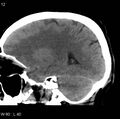 Cerebral hemorrhagic contusion with subdural and subarachnoid hemorrhage (Radiopaedia 10680-11146 C 5).jpg