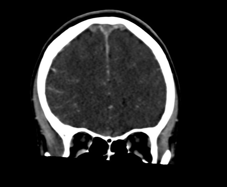 File:Cerebral venous sinus thrombosis (Radiopaedia 59224-66646 Coronal C+ delayed 19).jpg