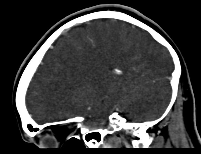 File:Cerebral venous sinus thrombosis (Radiopaedia 59224-66646 Sagittal C+ delayed 10).jpg