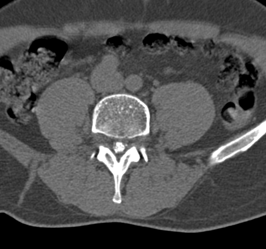 Cervical dural CSF leak on MRI and CT treated by blood patch (Radiopaedia 49748-54996 B 110).png