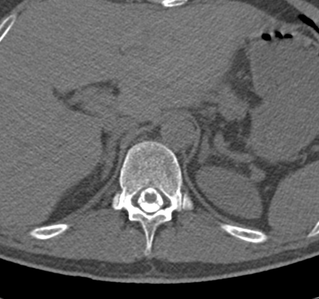 File:Cervical dural CSF leak on MRI and CT treated by blood patch (Radiopaedia 49748-54996 B 80).png