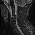 Cervical flexion teardrop fracture with cord hemorrhage (Radiopaedia 32497-33455 Sagittal STIR 7).jpg