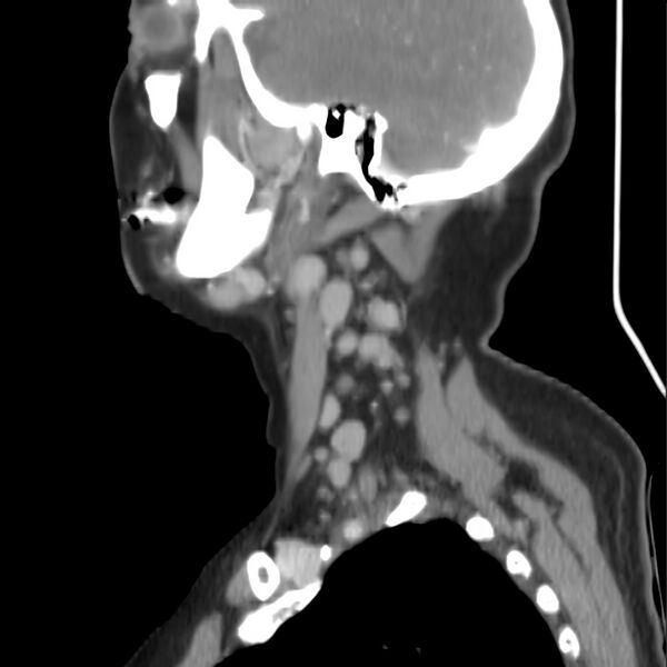 File:Cervical lymphadenopathy- cause unknown (Radiopaedia 22420-22457 D 8).jpg