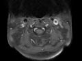 Cervical schwannoma (Radiopaedia 72399-82934 Axial T1 C+ fat sat 3).jpg