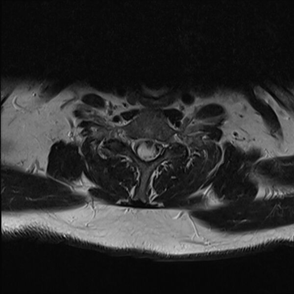 File:Cervical tumor-like myelopathy due to Type V dAVF (Radiopaedia 82461-96604 Axial T2 29).jpg