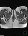 Cesarian scar endometriosis (Radiopaedia 68495-78066 Axial T1 29).jpg