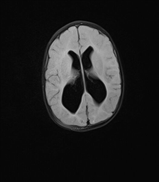 File:Chiari III malformation with occipital encephalocele (Radiopaedia 79446-92559 Axial FLAIR 17).jpg