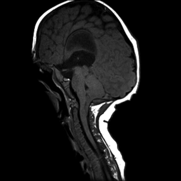 File:Chiari I and severe copper beaten skull (Radiopaedia 5993-77636 Sagittal T1 1).jpg