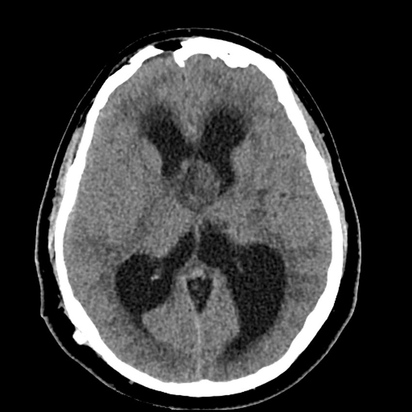 Chiasmatic-hypothalamic juvenile pilocytic astrocytoma (Radiopaedia 78533-91237 Axial non-contrast 30).jpg