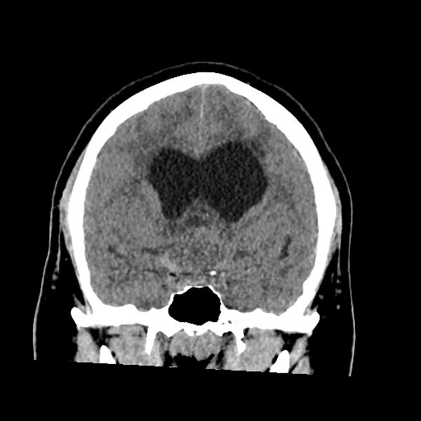 File:Chiasmatic-hypothalamic juvenile pilocytic astrocytoma (Radiopaedia 78533-91237 Coronal non-contrast 30).jpg
