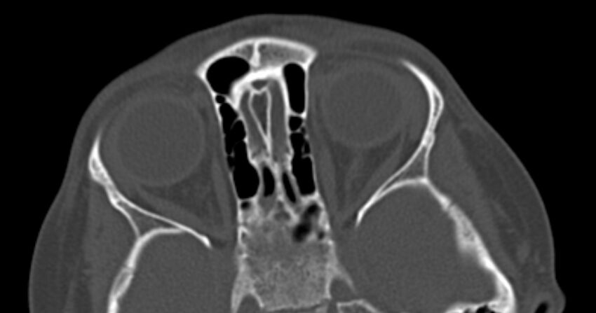 Choanal atresia (Radiopaedia 51295-56972 Axial bone window 49).jpg